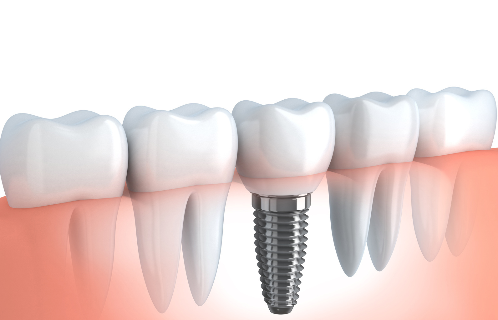 Implantes dentales Oral Prima